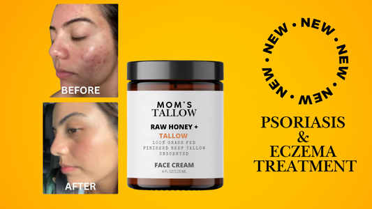 Skin Serenity Healing Face Cream (Psoriasis & Eczema Treatment)